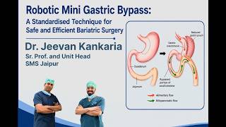 Robotic Bariatric Surgery | Mini-Gastric Bypass | MGB | Dr Jeevan Kankaria