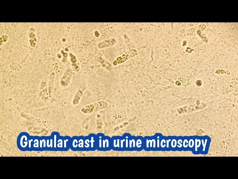 Granular cast in Urine microscopy