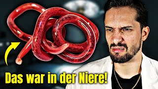 30 cm großer Parasit plötzlich in der Niere! Biologe klärt auf
