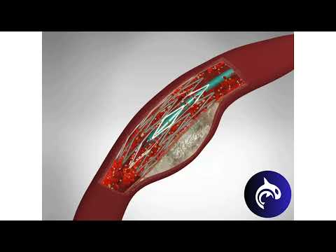 Quick View - Angioplasty and Stent Placement