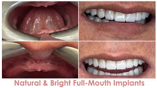 Natural & Bright Full-Mouth Implant Restoration