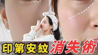 3分鐘淡化印第安紋，臉皮筋肉提拉術｜重現緊緻線條！