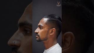 How Facial Balancing Defines Your Profile | Male Facial Balancing | Musk Clinic Ahmedabad