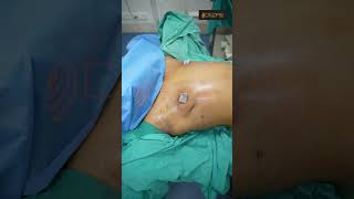 Keyhole FTM top Surgery result