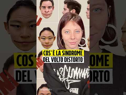 Cos'è la sindrome del volto distorto?