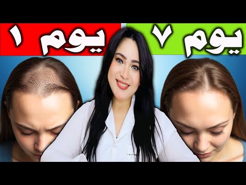 لو بتخسري شعرك خصلة ورا التانية .. الفيديو ده هينقذك في 7 أيام !!