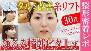 【絶対に失敗できない糸リフト整形密着】タルミを急改善してウェディングフォトを撮りたい30代女子のダウンタイムレポート【ほうれい線改善】湘南美容クリニック
