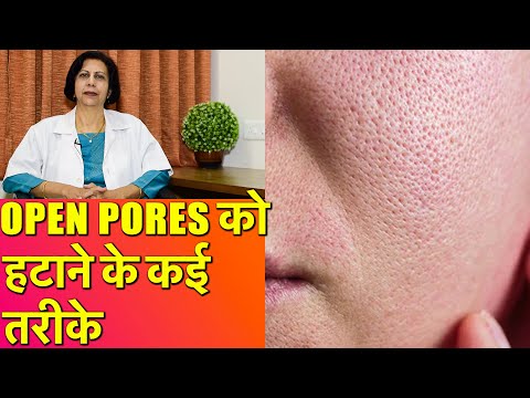 ओपन पोर्स को हटाने के कई तरीके || How To Get Rid of Large Open Pores (Permanent Treatments)