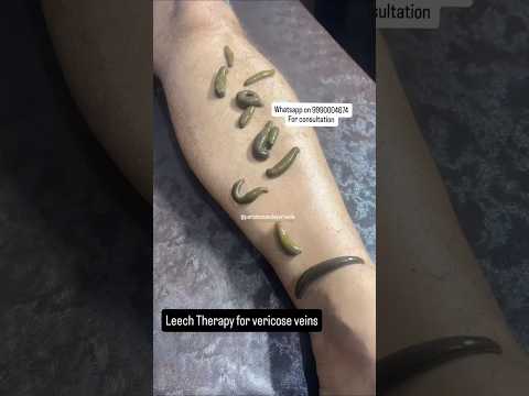 Varicose Veins Relief with Ayurvedic Leech Therapy | Natural Treatment #paramanandayurveda #ayurveda