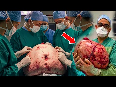 Ärzte dachten, sie sei schwanger – doch was sie aus ihrem Bauch holten, schockierte die ganze Welt!