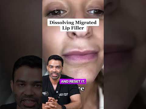 Why Did My Lip Filler Migrate? (And How to Fix It!)