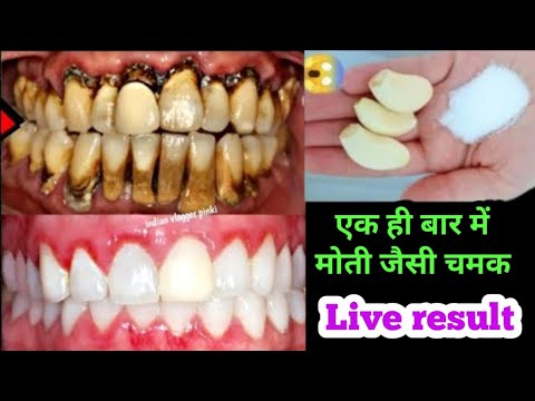 सिर्फ 2 मिनट में गंदे पीले दांतो को मोटी हो जैसे सफेद चमकदार बना देगा II teeth whitening/dant safed