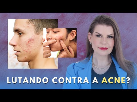 O TRATAMENTO PARA CURAR A ACNE / ESPINHA / OLEOSIDADE EXISTE E EU POSSO PROVAR