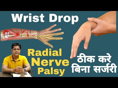 Physiotherapy Exercise For Wrist Drop.Wrist Drop का ईलाज। Radial nerve palsy.#wristdrop #wristpain