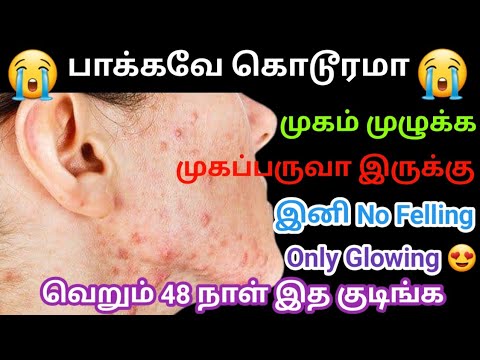 🙆‍♀️போச்சு எல்லாம் போச்சு அப்படின்னு புலம்பாதிங்க🥰 /How to get rid of pimples on face tamil#pimples