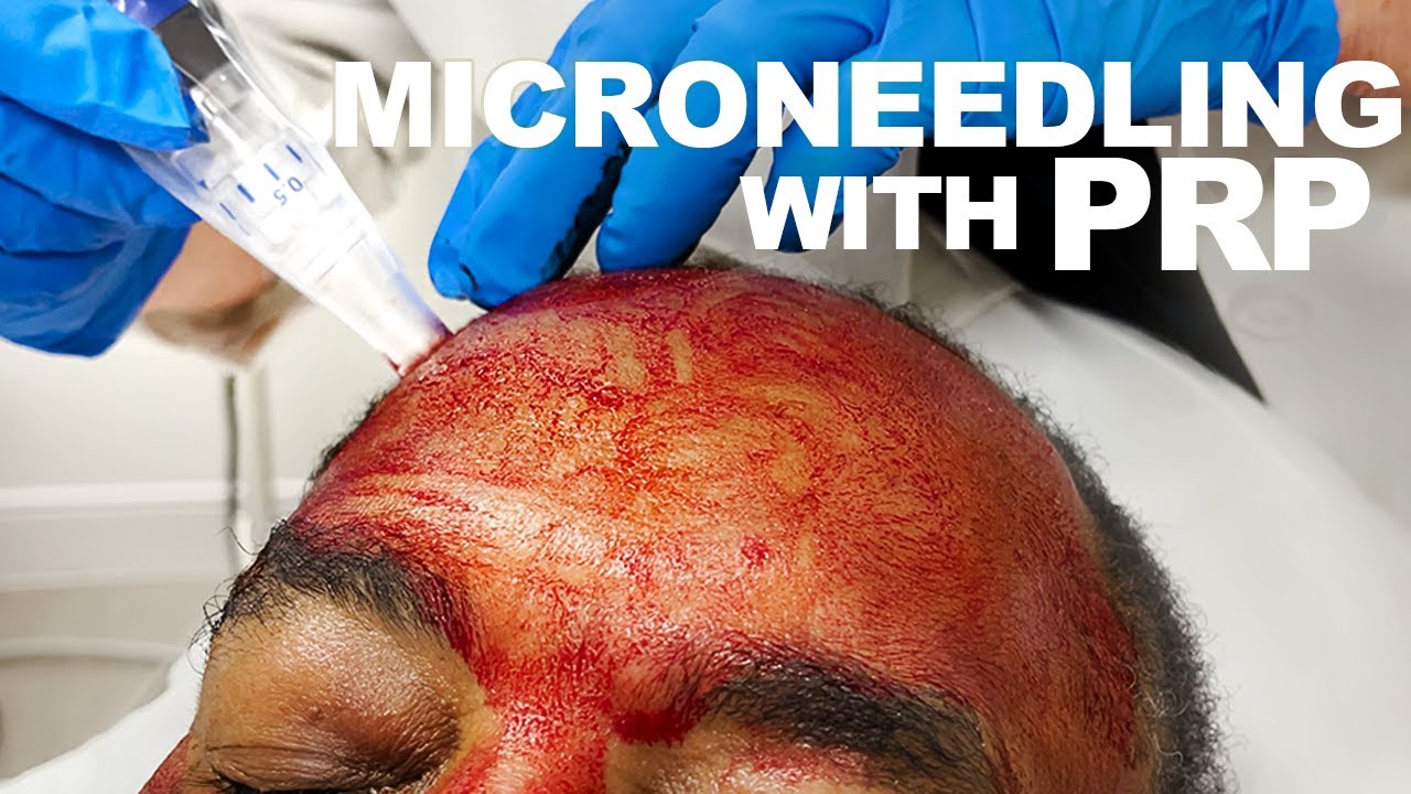 Microneedling procedure with PRP treatment on forehead.