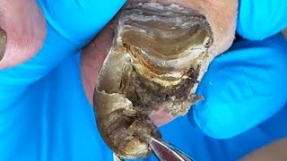 Perfect Transformation For Super Thick Onychomycosis!【Xue Yidao】