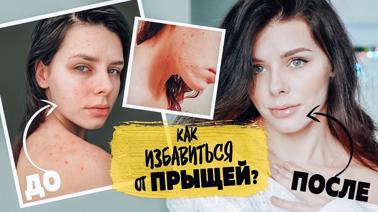 Как избавиться от ПРЫЩЕЙ? Мой УХОД. Тренировки и Высыпания.