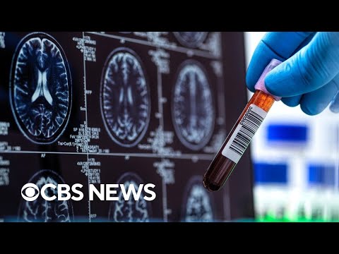 YouTube video thumbnail: Alzheimer's Association Says Some Blood Tests can be Used to Diagnose the Disease