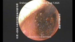 Routine cerumen impaction cleaning of the external auditory canal 20250807