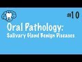 Salivary Gland Tumors Overview