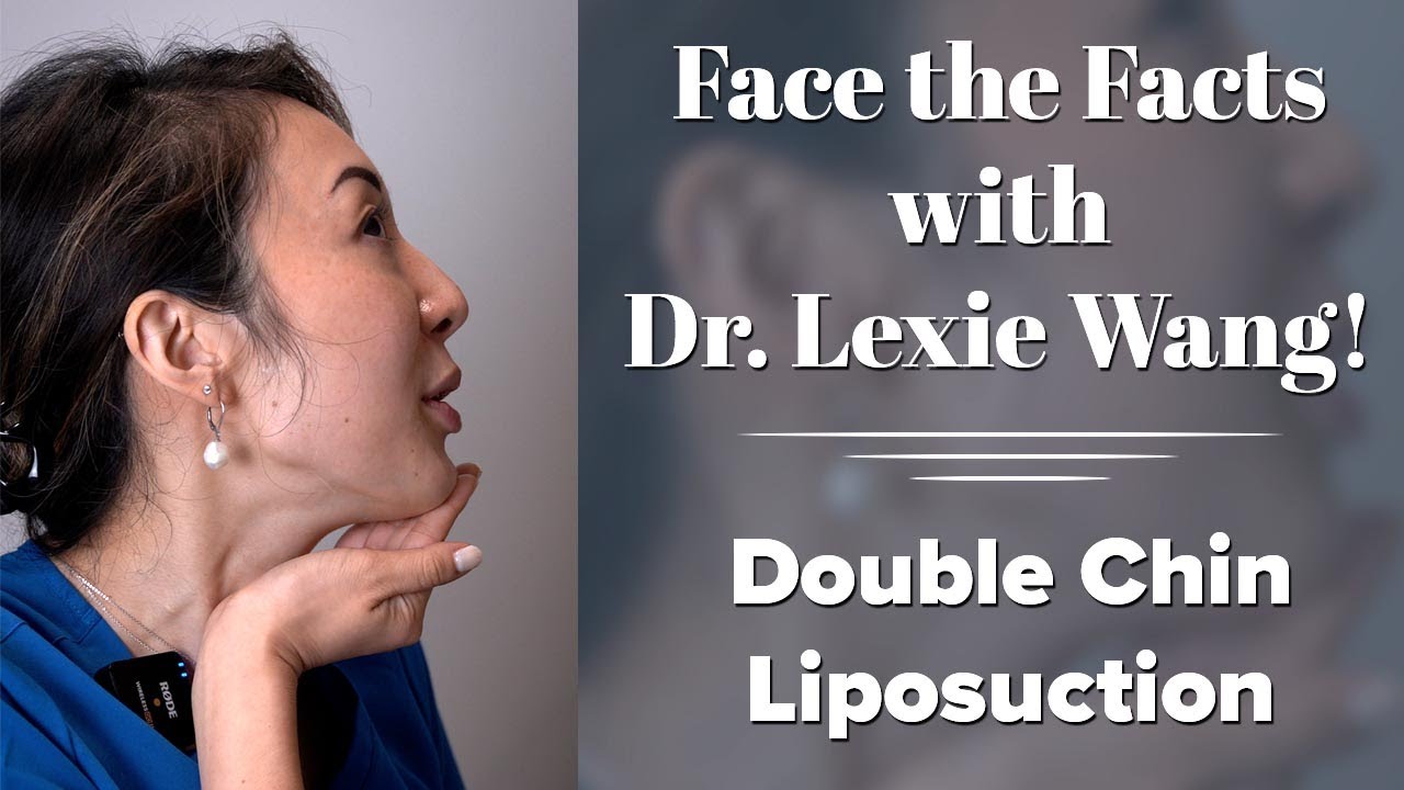 Dr. Lexie Wang discussing double chin liposuction.