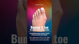 MINIMALLY INVASIVE BUNION & TOE STRAIGHTENING TRANSFORMATION✨#shorts #bunionsurgery #bunions