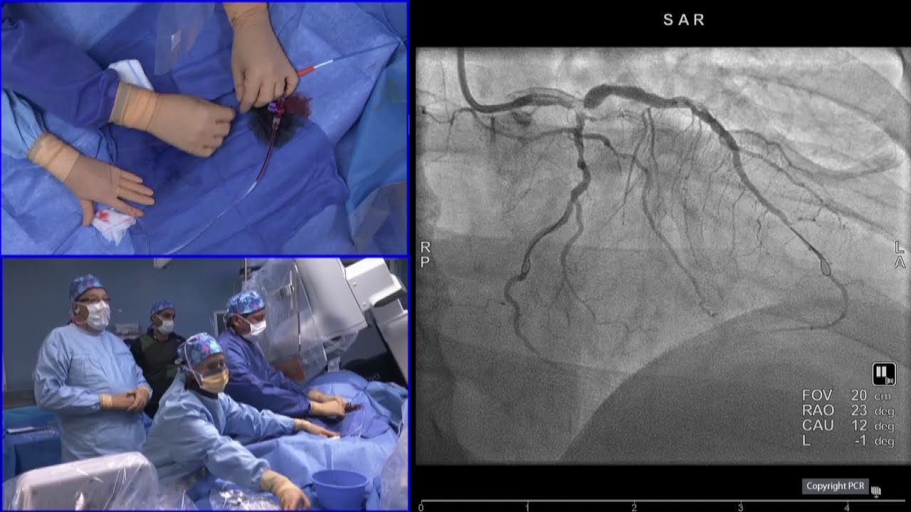 Complex PCI in high bleeding