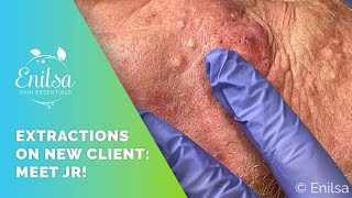 New Client! Many Extractions on JR