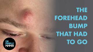 Dr. Pimple Popper vs. The Forehead Bump That Had To Go