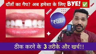 Tooth Gap Treatment 🦷 | दाँतों के बीच गैप कैसे करें ठीक? Cost + Best Options