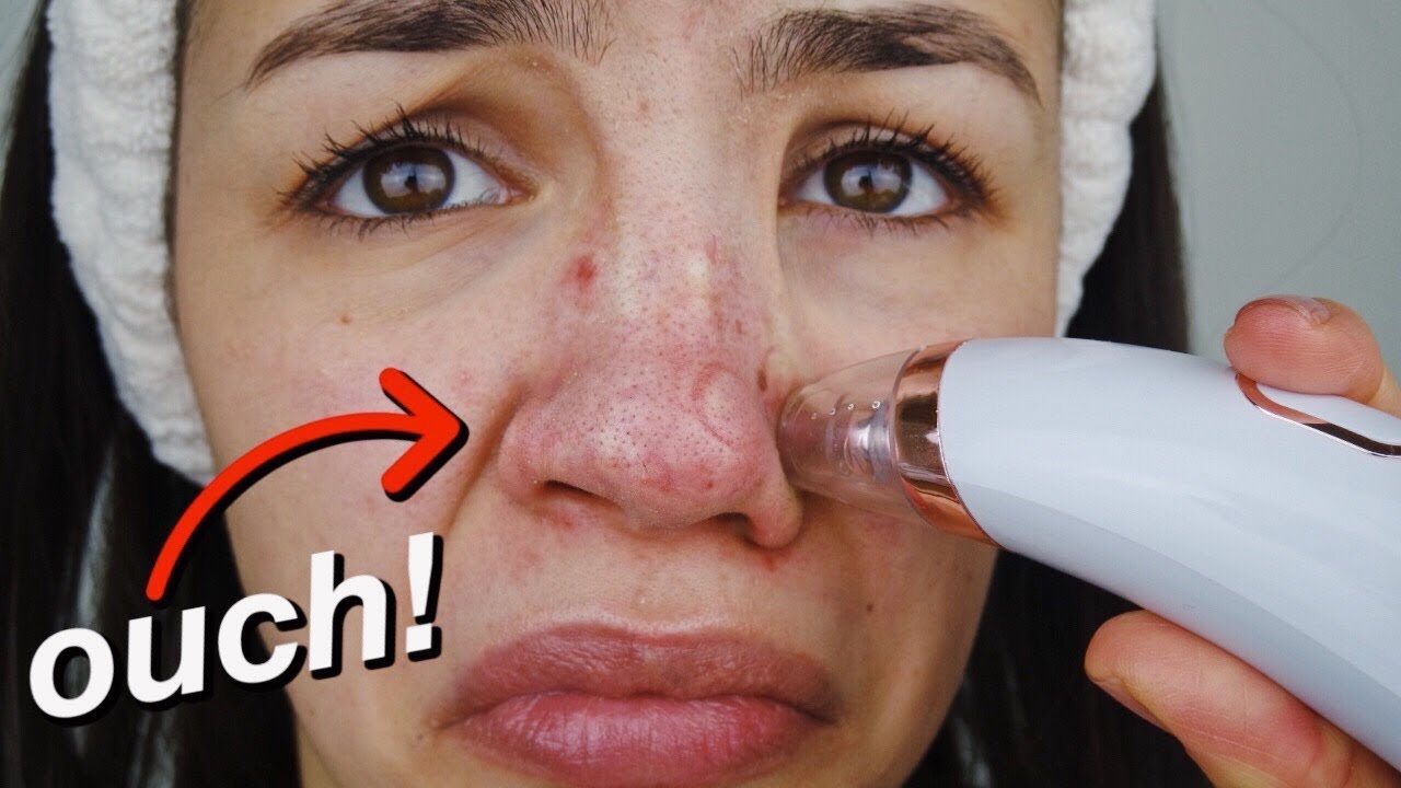 Pore + blackhead remover vacuum! -up close footage- - Audrey Victoria