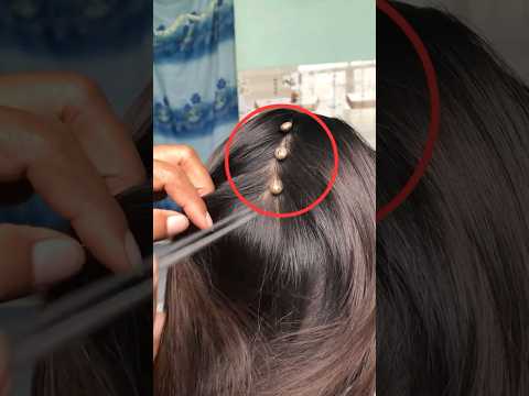 Rimase scioccato quando vide cosa gli usciva dai capelli.