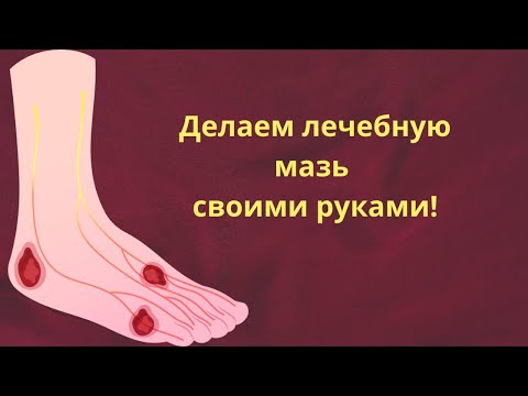 ПРОСТО ЛУЧШЕ! Смесь для заживления кожи при варикозе и трофических язвах