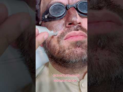 Carbon Peel Treatment #getsmarthairclub #hair #carbonlaserpeel