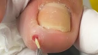 The Worst Toenail On Earth! “Thorn" Inside The Toe【Pedicure Master Lin Jun】