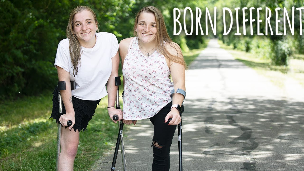 The twins who used to share one body - born different
