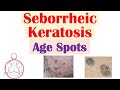 Seborrheic Keratosis Characteristics and Treatment