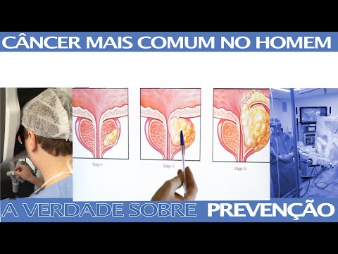 Câncer de Próstata - Estatística e Prevenção