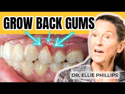 How to Avoid Gum Recession & Grow Back Gums