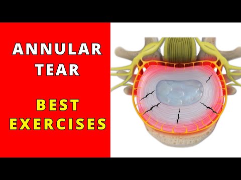 What is Annular Tear? What is the best exercise to maximise your healing and reduce your pain