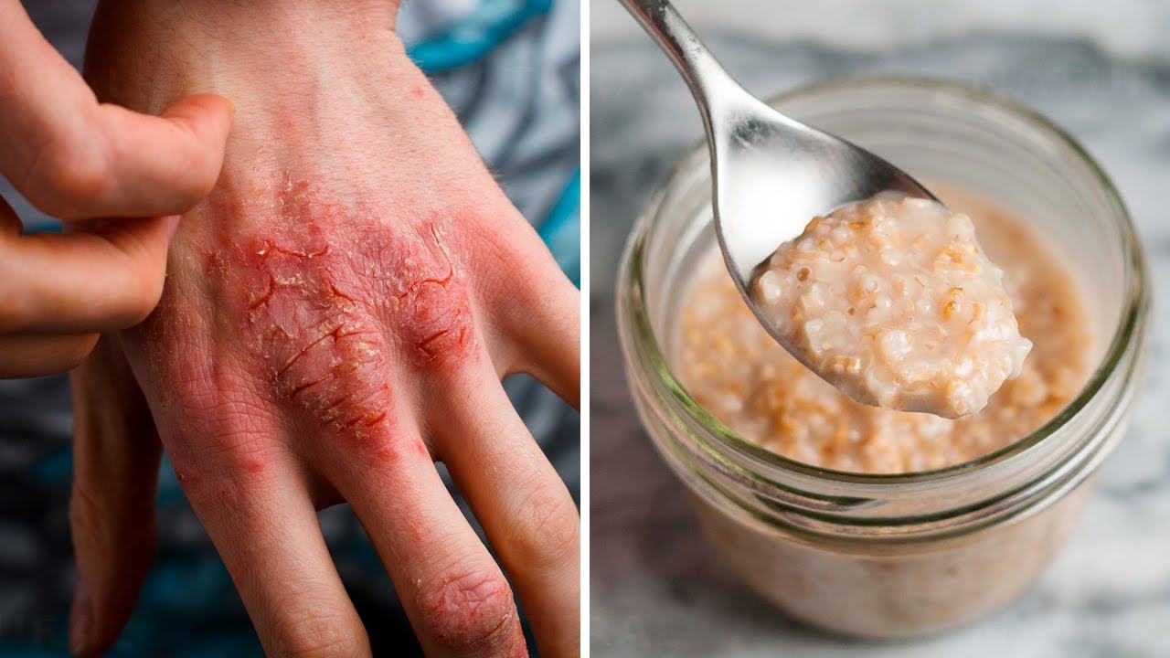 How to cure Eczema Naturally