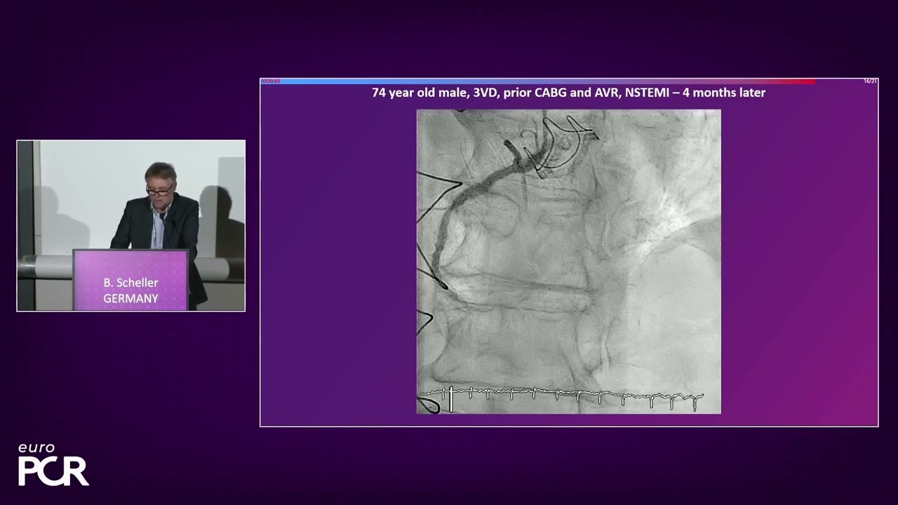Complex coronary artery