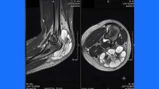 “Goose Egg” on the Elbow! 😮 | Massive Olecranon Bursitis on Ultrasound