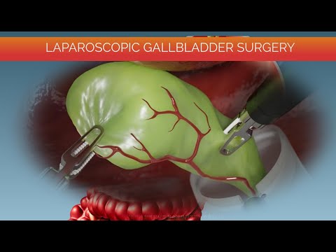 Laparoscopic Gallbladder Surgery - Cholecystectomy Procedure// Gallbladder Removal animation