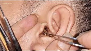 耳掃除の難聴 最大の耳垢除去34