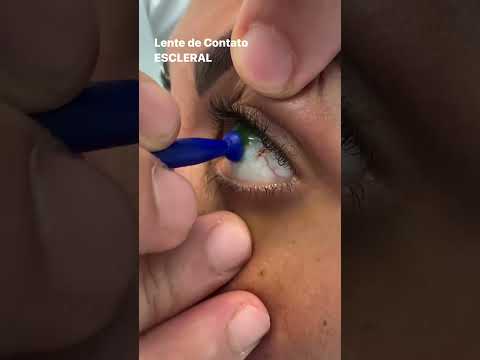 TIRAR  LENTE ESCLERAL com VENTOSA / DICA RÁPIDA