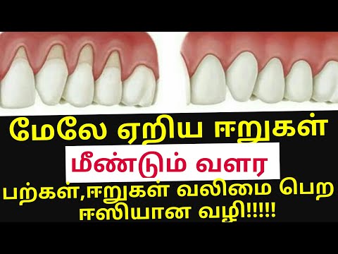 ஈறுகள் மேலே ஏறி அசிங்கமாக உள்ளதா! Receding gums home remedy
