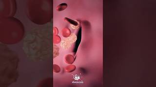 Heart Blockage Test: What Is a Coronary Angiogram?