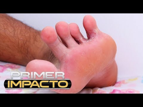 Frotar ajo crudo en los pies, el remedio natural para curar el pie de atleta